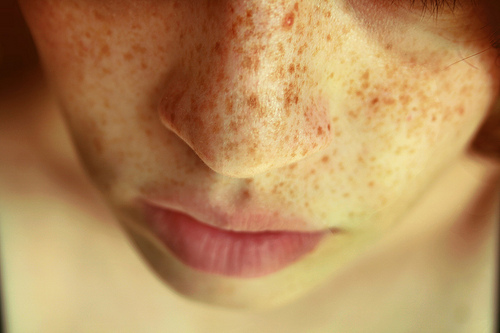 Freckles